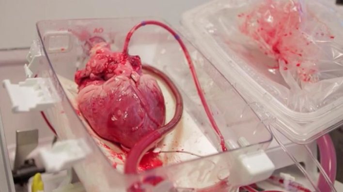 Инновационная операция позволила вернуть к жизни мёртвое сердце