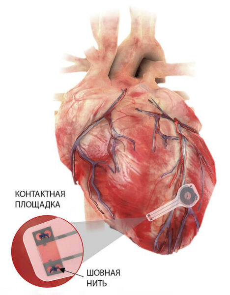 Кардиостимулятор будущего — без батареек и растворяется в организме, когда больше не нужен