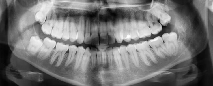 Открыт новый способ лечения зубов не требующий сверления и пломб