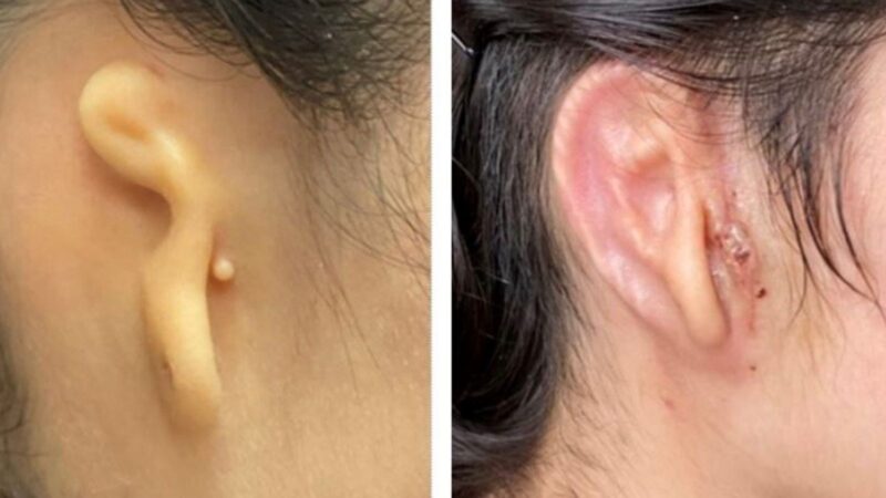 Молодой женщине имплантировали 3D-печатное ухо, и теперь она не стесняется своей внешности!